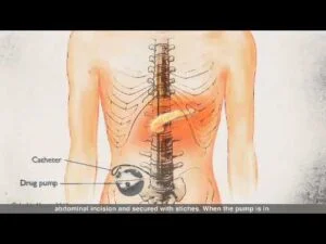 Awake Brain Tumour Surgery
