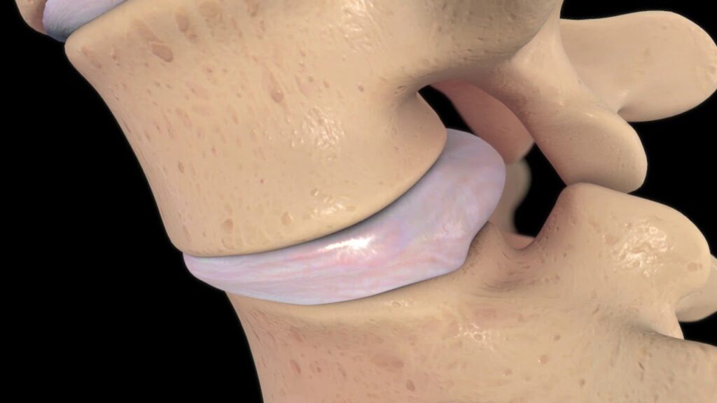 Endoscopic Third Ventriculostomy